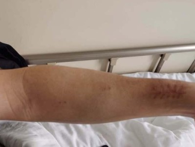 精神分裂症的表现（了解精神分裂症的症状与征兆，及时进行干预）